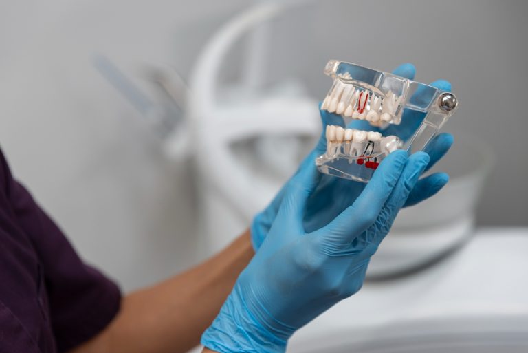 Descubre cuántos implantes necesitas para una sonrisa completa