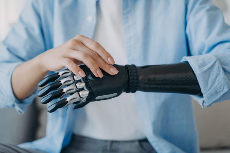 Las prótesis de brazo biónico incorporan las tecnologías más innovadoras